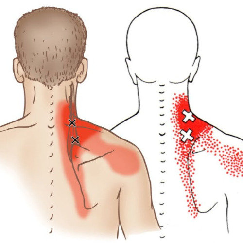 如何有效缓解肩颈酸痛